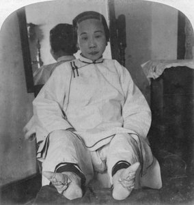 Delikátní nohy lilií vysoké kasty, ukazující metodu deformace, Čína, 1900.